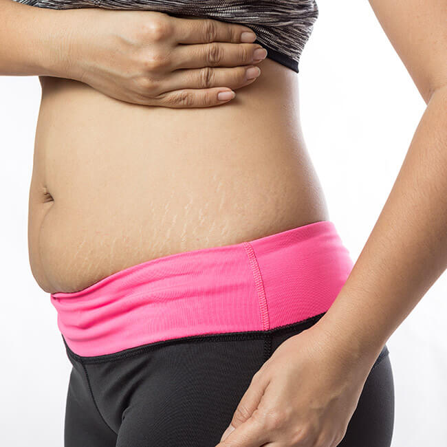 stretch marks removal treatment in hyderabad